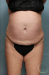 Liposuction Case 51 Before